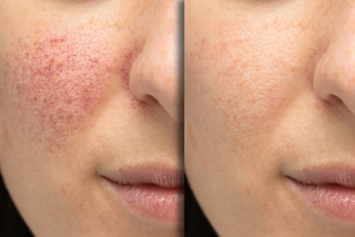 acne treatment korean