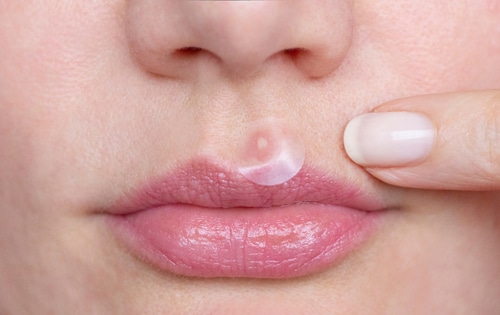 Korean pimple patches