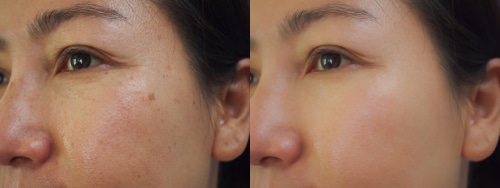 korean wrinkle cream before and after