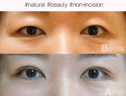 Do all Koreans get double eyelid surgery