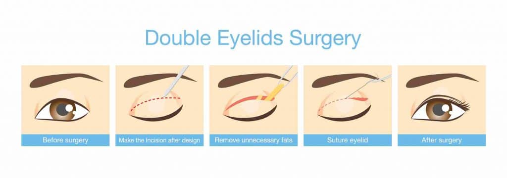 how common is double eyelid surgery in korea