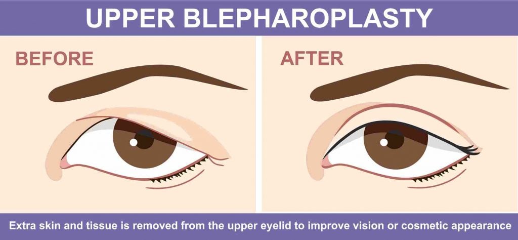 double eyelid surgery meaning