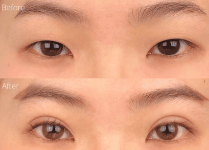 non incisional double eyelid surgery